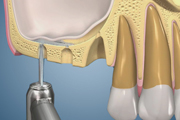 Hydraulic Sinus Lift